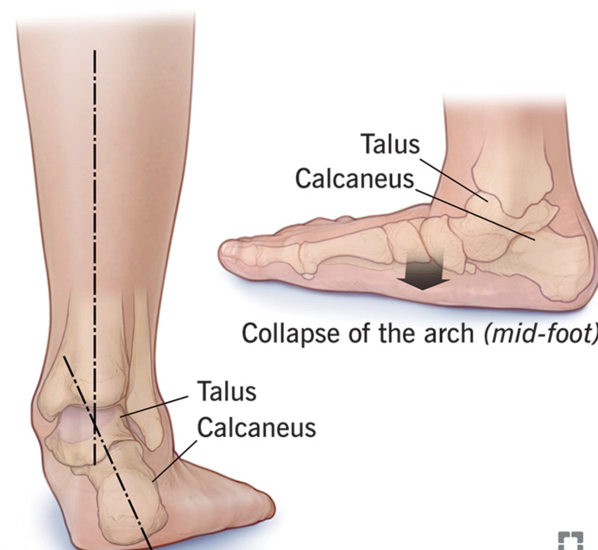 CTB Hyperpronation Correction System: Insole Kit
